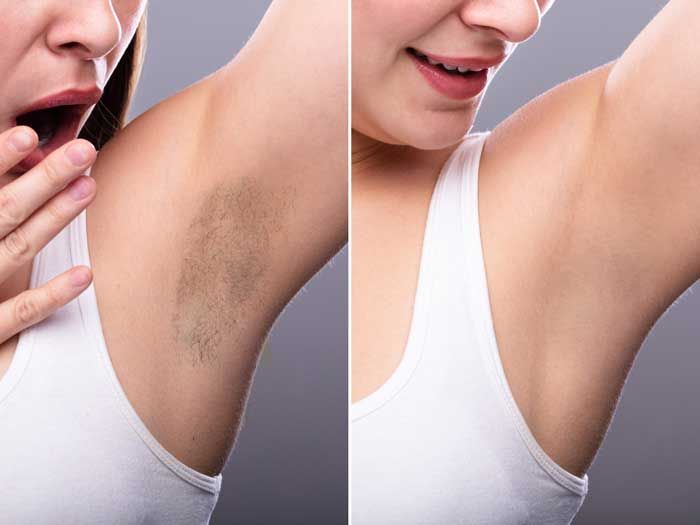 Axilas antes y después de la depilación con láser